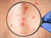 Thumbnail for article : Additional Case Of Monkeypox Confirmed In Scotland