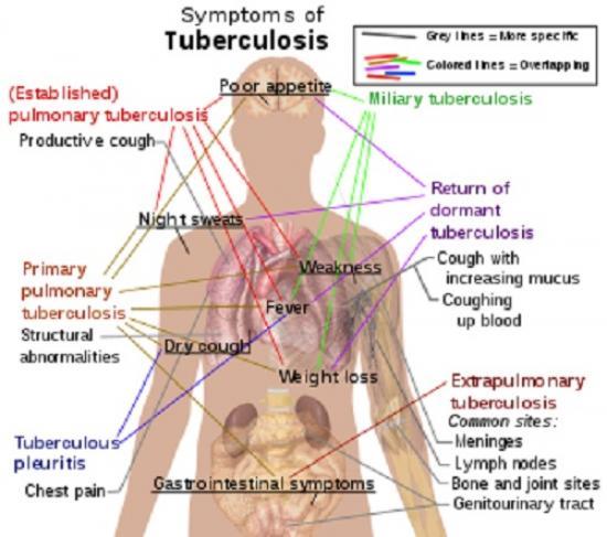 Photograph of Russia's Invasion Of Ukraine Poses A Threat To The Control Of Drug-resistant TB In Europe And The World