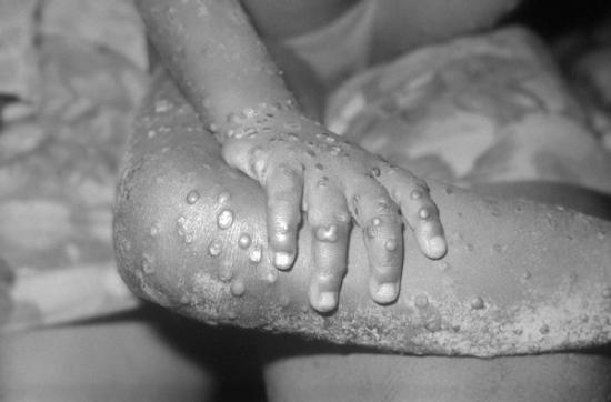Photograph of Monkeypox Isn't Like HIV, But Gay And Bisexual Men Are At Risk Of Unfair Stigma